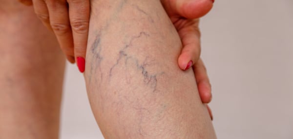 Varicose Veins Learn About the Main Risk Factors