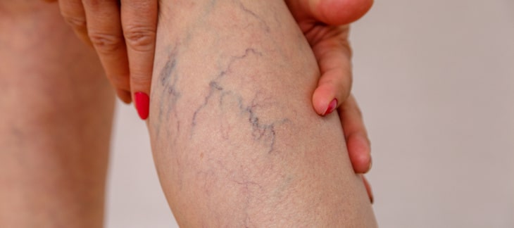 Varicose Veins Learn About the Main Risk Factors